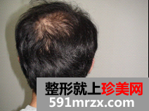 因为想找女朋友 在北京做了无痕植发