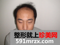 因为想找女朋友 在北京做了无痕植发