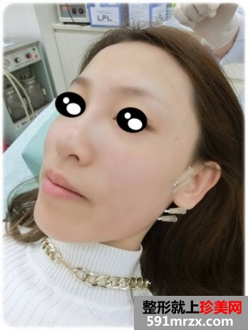 沈阳协和整形美容医院玻尿酸隆鼻后 终于不用狂打鼻影了