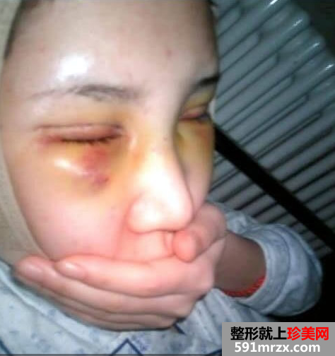 看我去北京做的韩式三点双眼皮恢复过程 有一点点恐怖