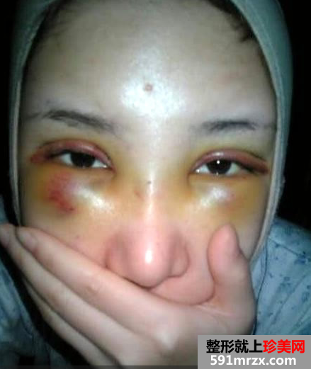看我去北京做的韩式三点双眼皮恢复过程 有一点点恐怖