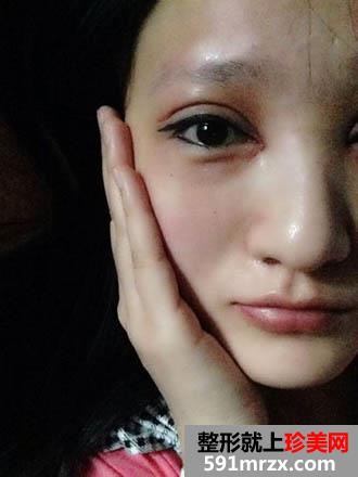 终于做了开眼角和全切双眼皮 恢复ing