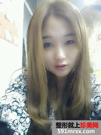 单眼皮妹纸割双眼皮实现美丽双眼的愿望