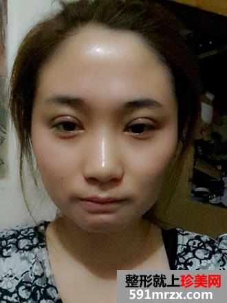 单眼皮妹纸割双眼皮实现美丽双眼的愿望