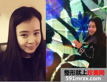 佀同帅割双眼皮