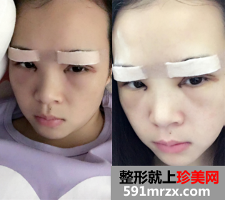 割双眼皮