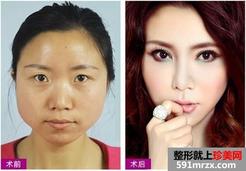 自体脂肪改脸型，微整形瘦脸，微创精雕双眼皮