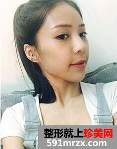 塌鼻子隆鼻前后对比居然改变这么大~~~