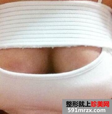 26岁天生胸平做了20°少女CC美胸术后效果分享