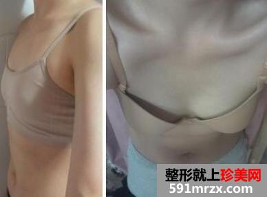 26岁天生胸平做了20°少女CC美胸术后效果分享
