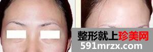 激光洗眉 让我找回那美妙的大学时光