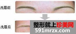 激光洗眉 让我找回那美妙的大学时光