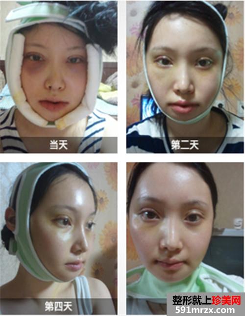 欧式双眼皮+下颌角缩小术真实案例前后对比图和恢复过程
