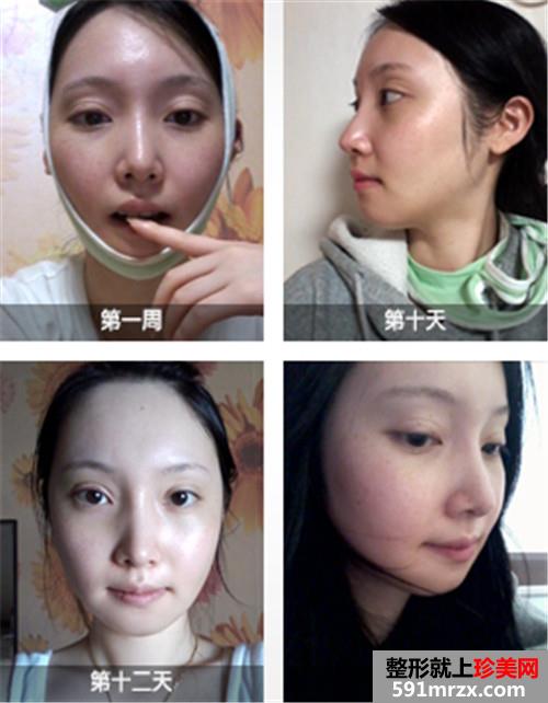 欧式双眼皮+下颌角缩小术真实案例前后对比图和恢复过程