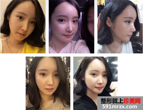 欧式双眼皮+下颌角缩小术真实案例前后对比图和恢复过程