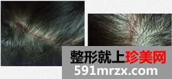 韩国发际线调整真人秀