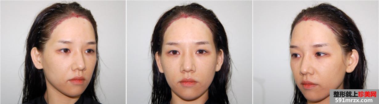 韩国多娜发际线调整真人秀术后当天