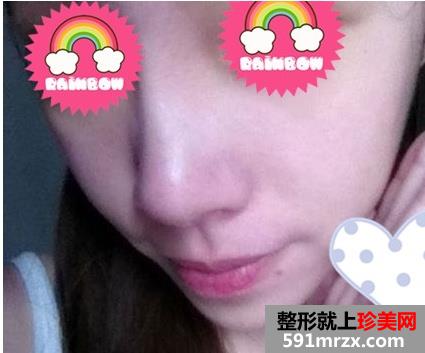 北京自体软骨隆鼻好吗
