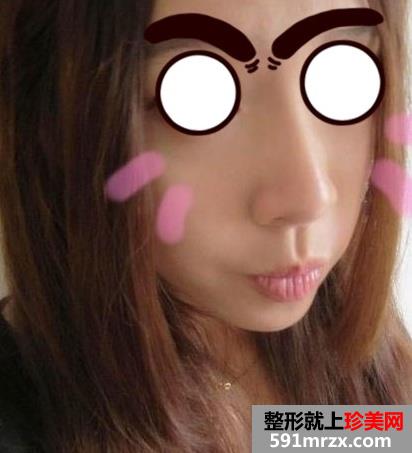 北京自体软骨隆鼻好吗