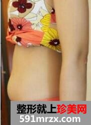 北京腰腹吸脂减肥效果赘肉SAY拜拜