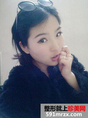 内双做双眼皮手术