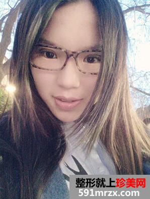 内双做双眼皮手术