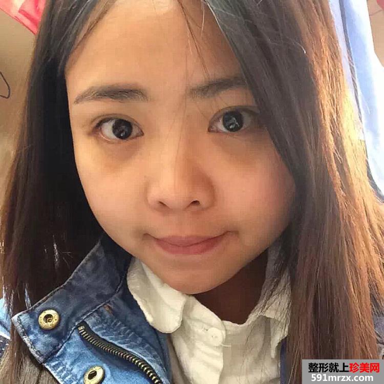 内切祛眼袋多久恢复 广州美莱祛眼袋案例