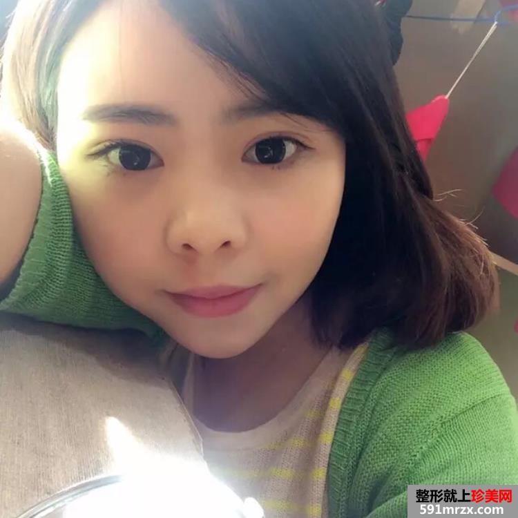 内切祛眼袋多久恢复 广州美莱祛眼袋案例
