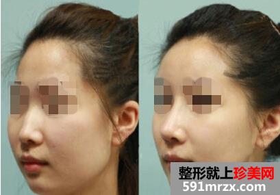 温州做假体隆鼻价格大概要多少钱
