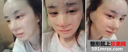 自体肋软骨隆鼻+额头填充自体脂肪整形前后对比图和恢复过程后记