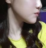 下颌角磨骨术恢复 四方女变成锥子脸的亲身经历分享
