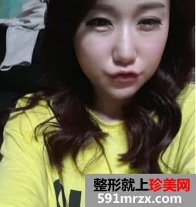 下颌角磨骨术恢复 四方女变成锥子脸的亲身经历分享