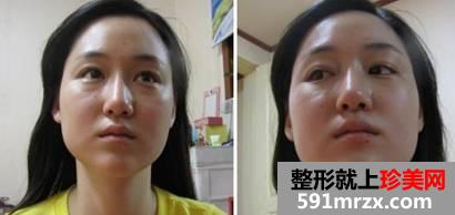 下颌角磨骨术恢复四方女变成锥子脸的亲身经历分享