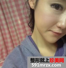 下颌角磨骨术恢复 四方女变成锥子脸的亲身经历分享