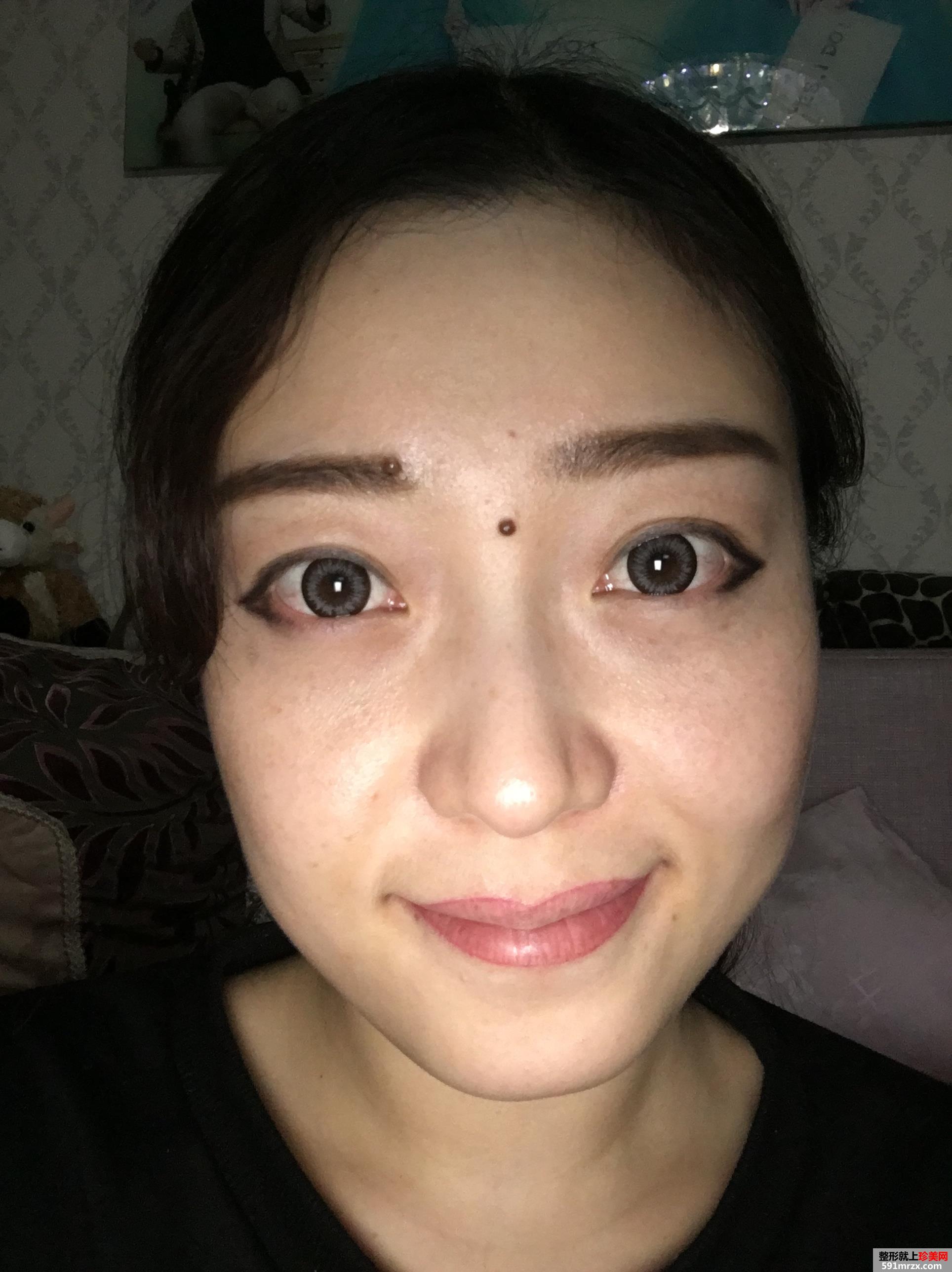无痕去眼袋效果好吗 北京华韩无痕去眼袋