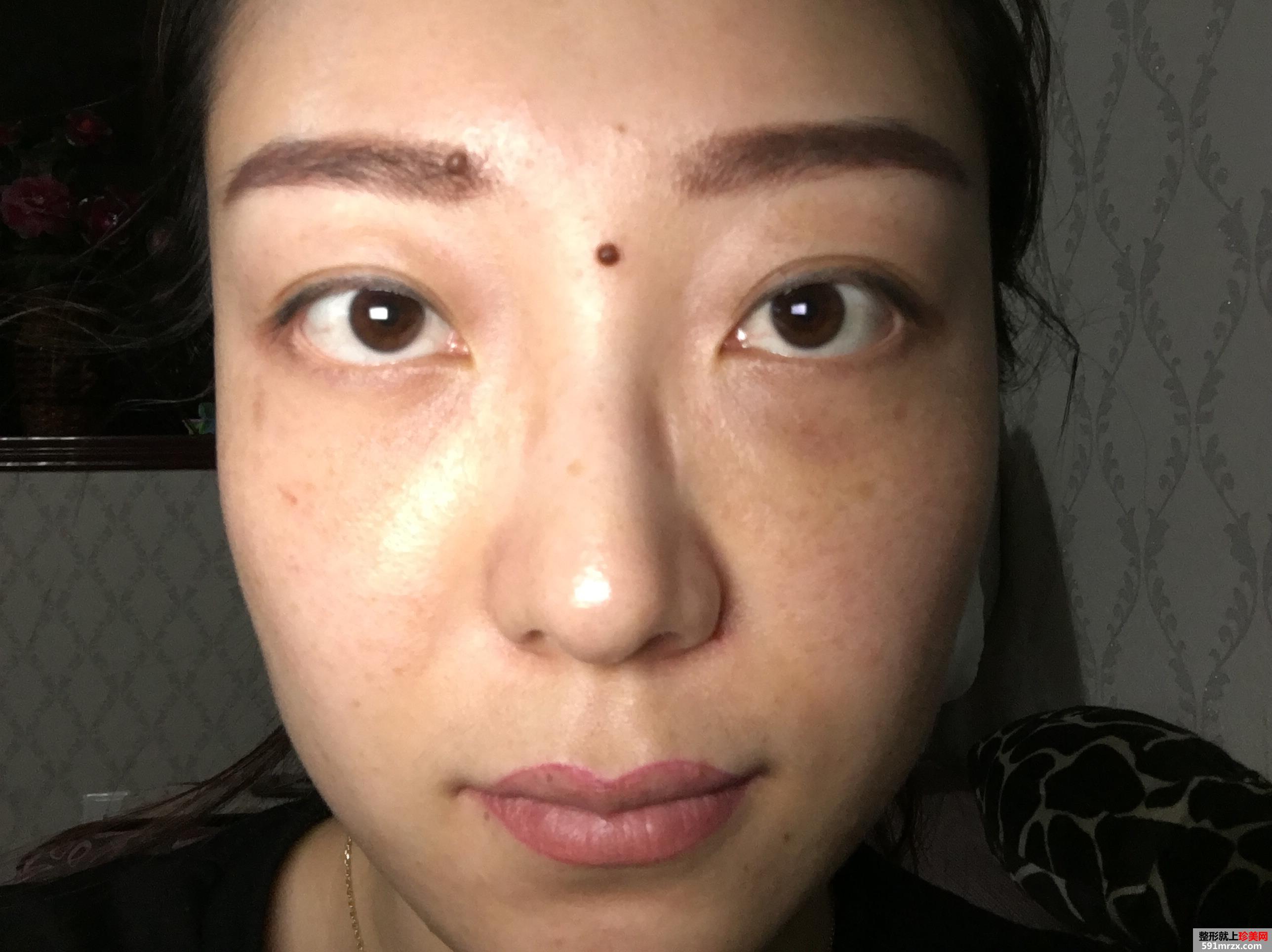 无痕去眼袋效果好吗 北京华韩无痕去眼袋