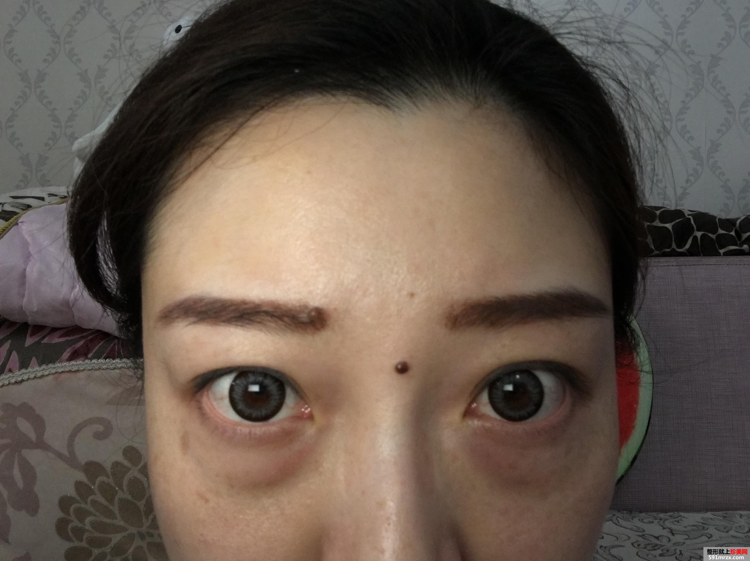 无痕去眼袋效果好吗 北京华韩无痕去眼袋