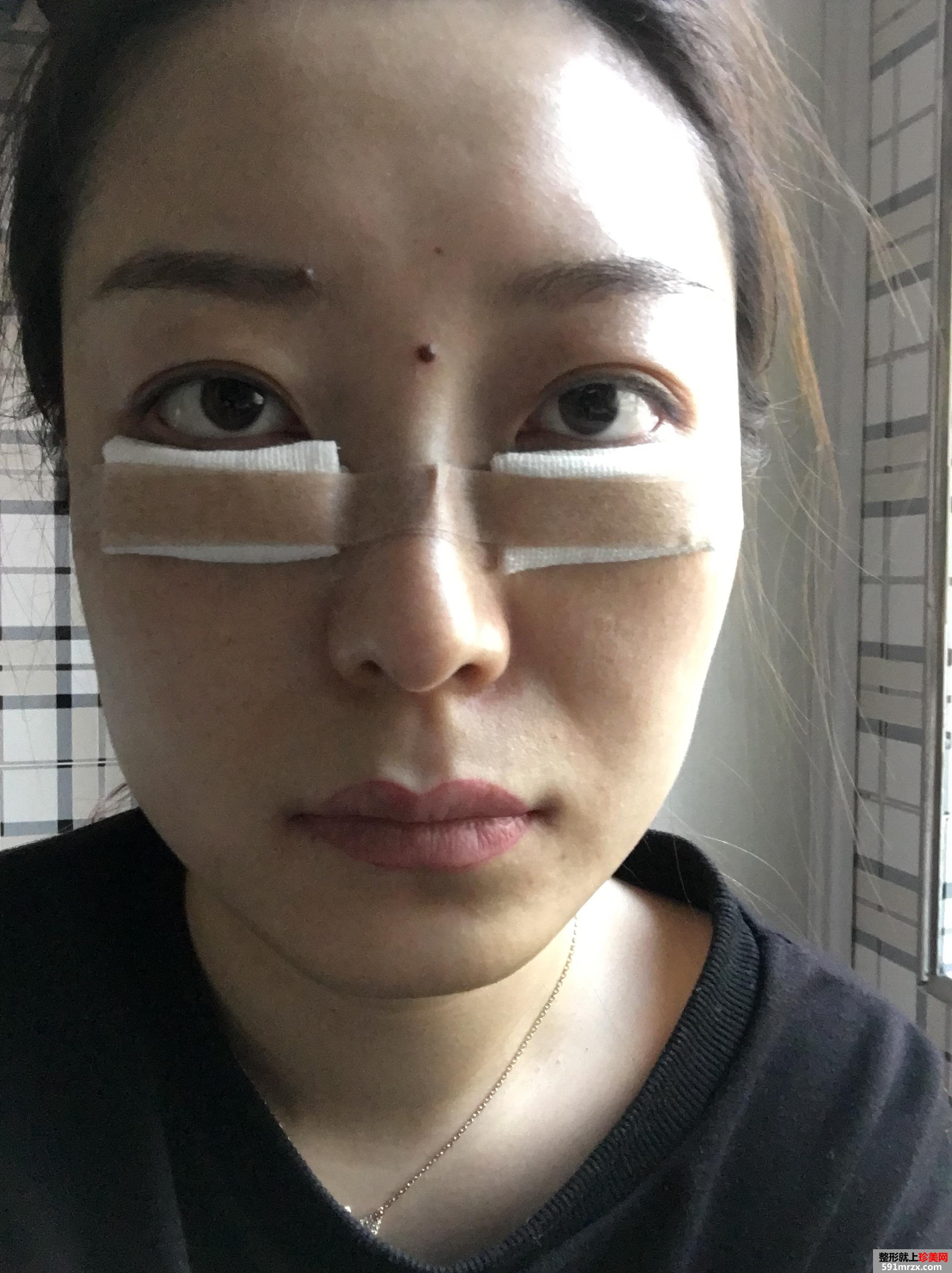 无痕去眼袋效果好吗 北京华韩无痕去眼袋