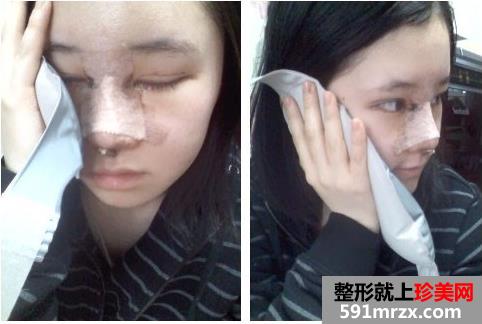 割双眼皮恢复过程图分享 双眼皮+隆鼻经历