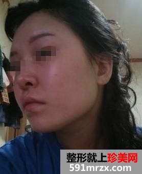 磨骨整形+双眼皮手术后年轻美貌