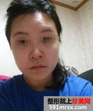 磨骨整形+双眼皮手术后年轻美貌