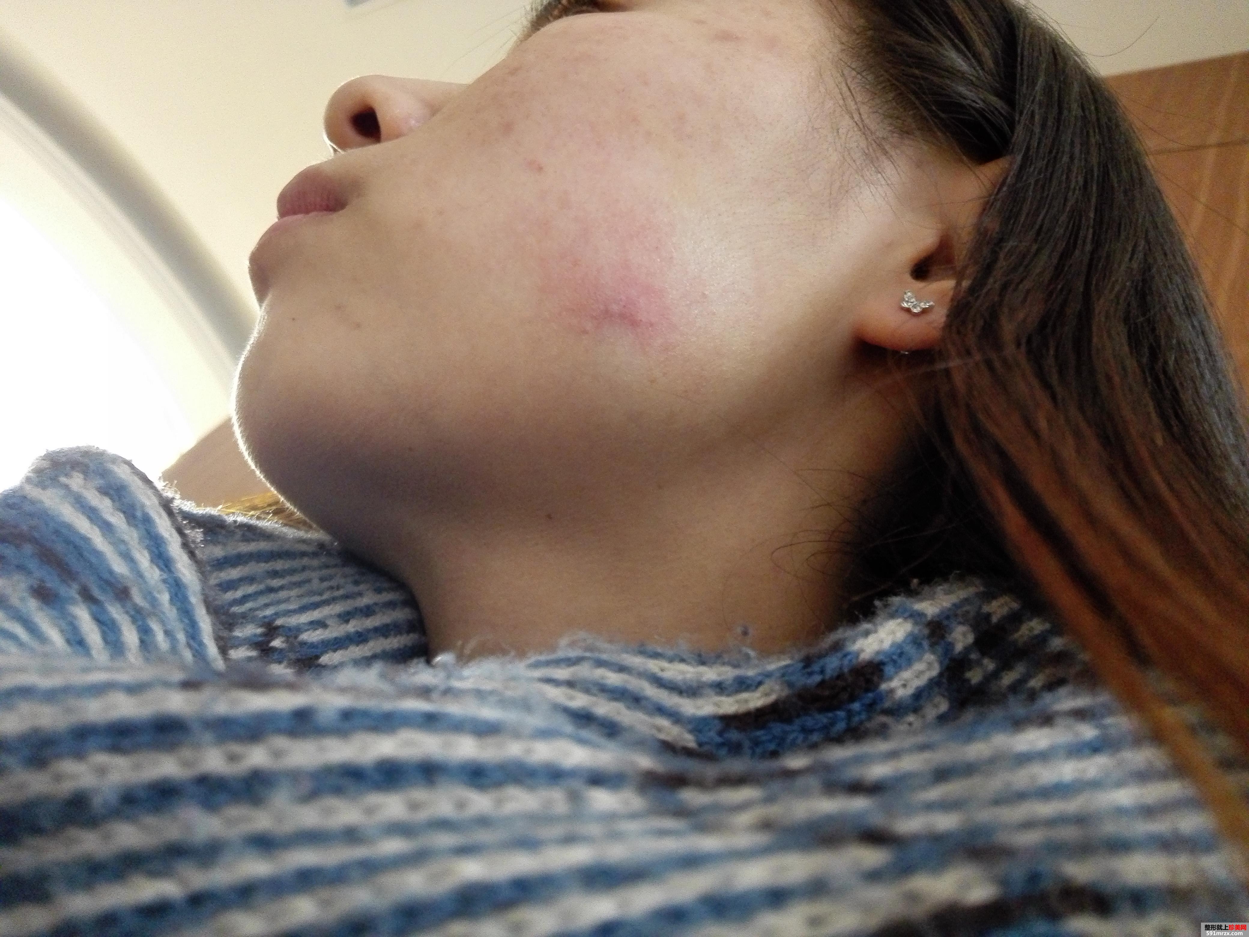 注射瘦脸针多久见效 北京安贞瘦脸针注射案例