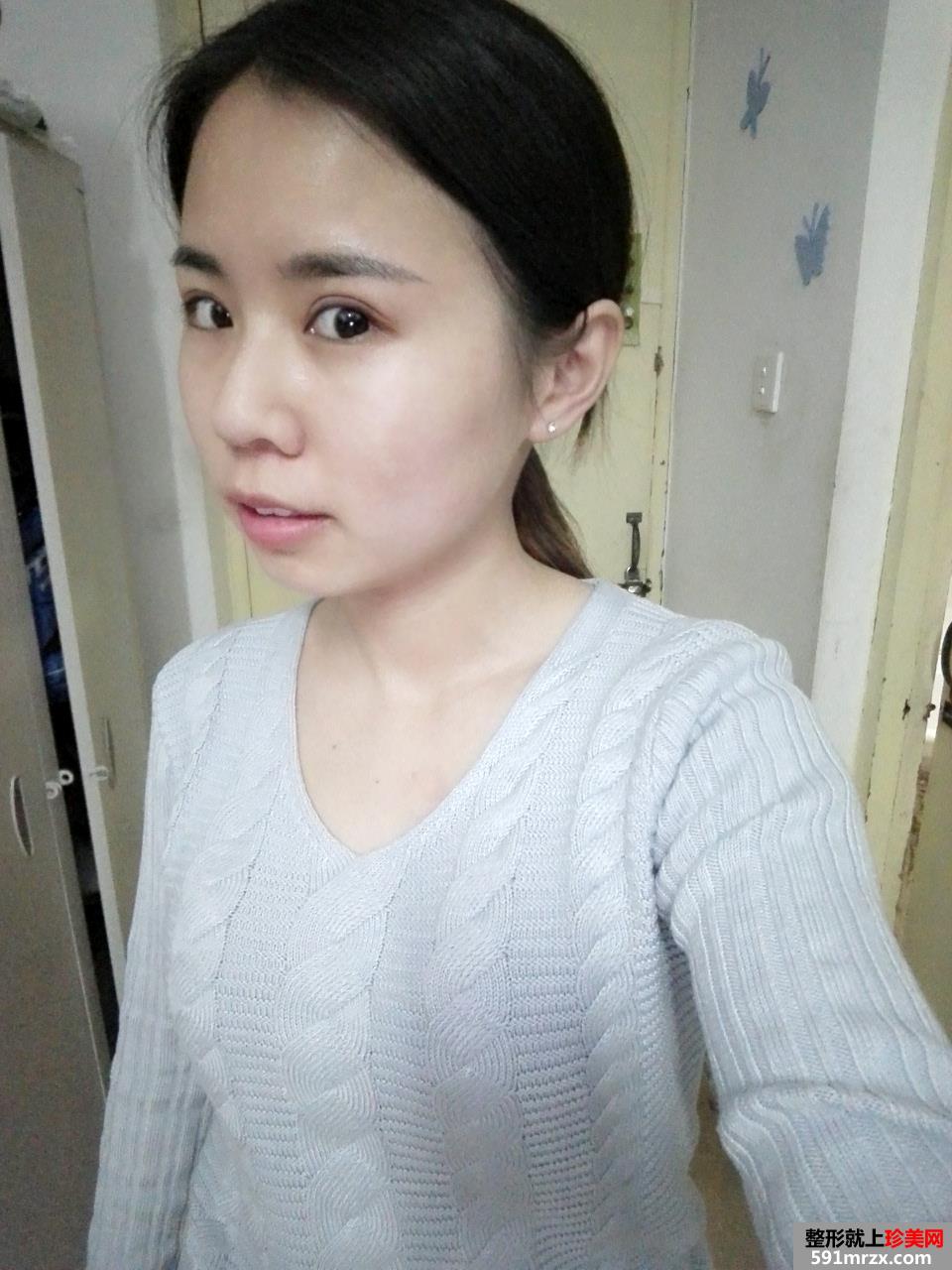 注射瘦脸针多久见效 北京安贞瘦脸针注射案例