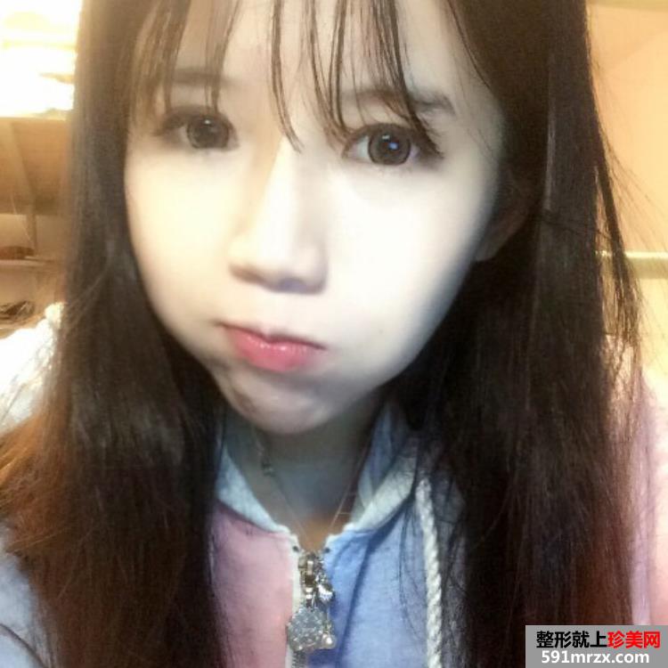 激光美白后对比照片 上海华美激光美白日记