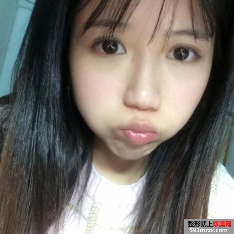 激光美白后对比照片 上海华美激光美白日记