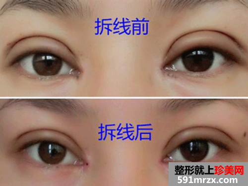 汕头,名流,整形,医院,全切双眼皮,开内眼角,气质