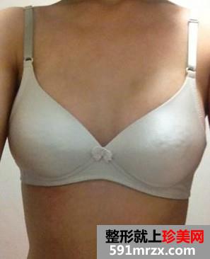麦格乳房假体隆胸过程 30岁妈妈的真实经历