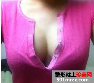 麦格乳房假体隆胸过程 30岁妈妈的真实经历