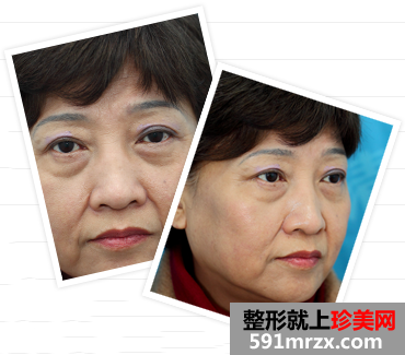 沈阳,杏林,整形,医院,面部,年轻化,再追一把,青春