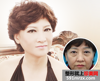 沈阳,杏林,整形,医院,面部,年轻化,再追一把,青春